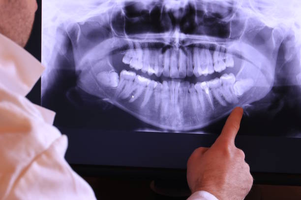 Best Emergency Wisdom Teeth Removal in Brookhaven, MS